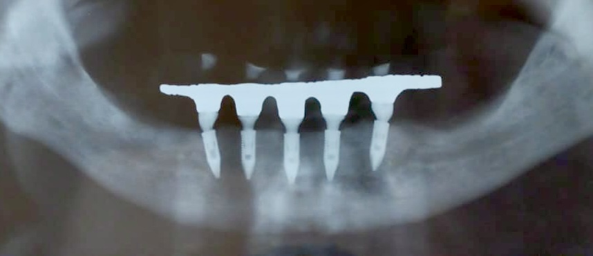 Radiografia com implantes dentários instalados na mandíbula