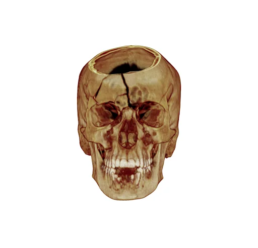 Reconstrução tridimensional de estrutura óssea facial